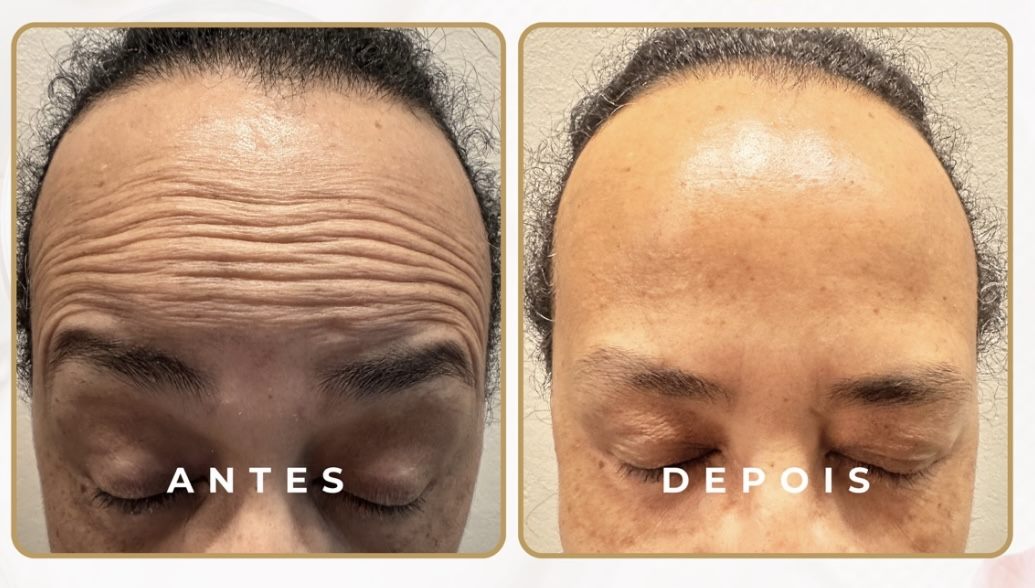 Antes e depois — botox