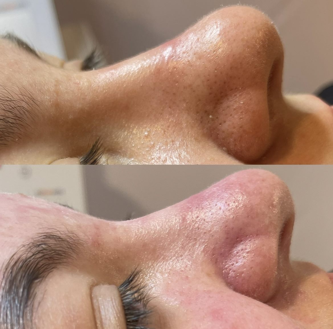 Antes e depois — dermaplaning
