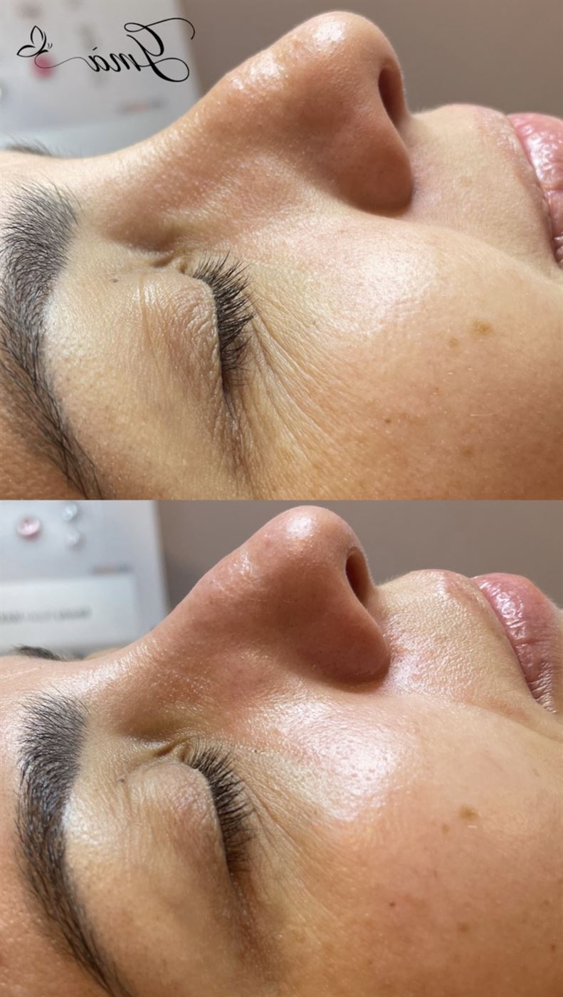 Antes e depois — limpeza de pele