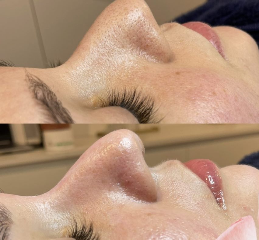 Antes e depois — pele de seda